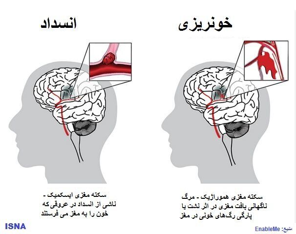 اصلی‌ترین عاملِ خطِر سکته مغزی در همه کشورها یکسان است